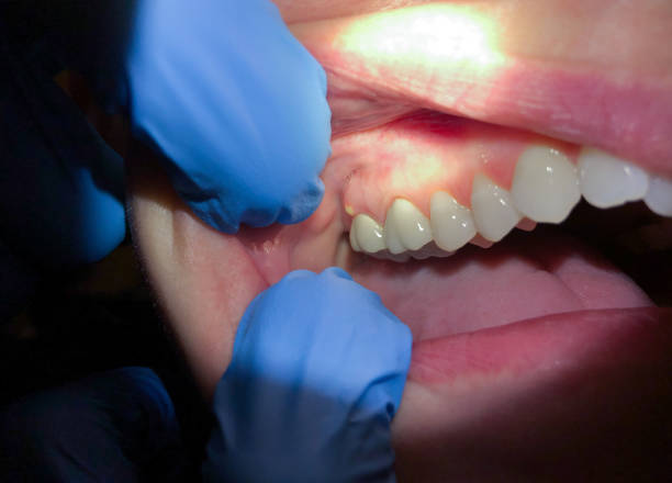 Best Emergency Dentist for Knocked-Out Tooth in Hueytown, AL